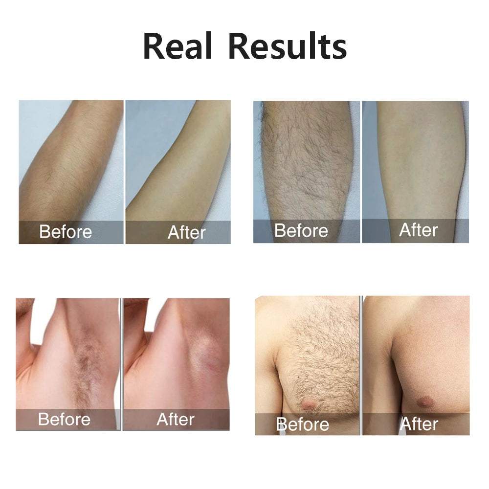 Permanent Laser Epilator 999999 Flashes Professional Painless Laser Hair Removal Machine for Women Body Facial Legs Bikini Line